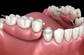 Removable Partial dentures